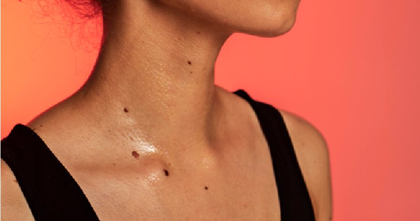 Keloid Treatment In Bangalore